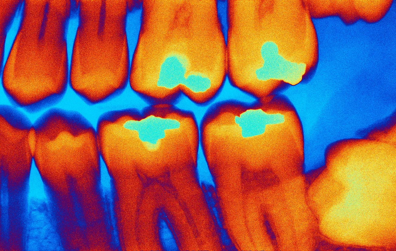 Falling into decay: the sorry state of our children's teeth
